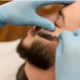 Beard transplant in Istanbul